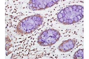 Paraformaldehyde-fixed, paraffin embedded human colon carcinoma tissue, Antigen retrieval by boiling in sodium citrate buffer(pH6) for 15min, Block endogenous peroxidase by 3% hydrogen peroxide for 30 minutes, Blocking buffer (normal goat serum) at 37°C for 20min, Antibody incubation with TIA1 Polyclonal Antibody, Unconjugated  at 1:500 overnight at 4°C, followed by a conjugated secondary and DAB staining (TIA1 antibody  (AA 101-200))