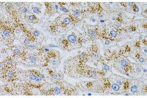 Immunohistochemistry of paraffin-embedded Human liver damage using NPC2 Polyclonal Antibody at dilution of 1:100 (40x lens).