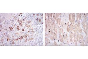 Immunohistochemical analysis of paraffin-embedded breast cancer tissues (left) and cardiac muscle tissues (right) using HSP27 mouse mAb with DAB staining.