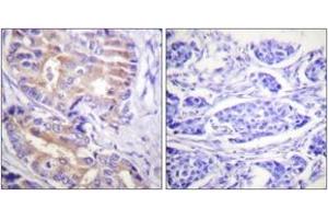 Immunohistochemistry analysis of paraffin-embedded human breast carcinoma tissue, using p70 S6 Kinase (Ab-389) Antibody. (RPS6KB1 antibody  (AA 355-404))