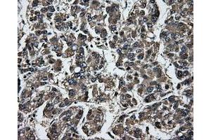 Immunohistochemical staining of paraffin-embedded Carcinoma of liver tissue using anti-GBE1mouse monoclonal antibody. (GBE1 antibody)