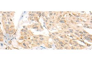 Immunohistochemistry of paraffin-embedded Human esophagus cancer tissue using CCT8L2 Polyclonal Antibody at dilution of 1:45(x200) (CCT8L2 antibody)