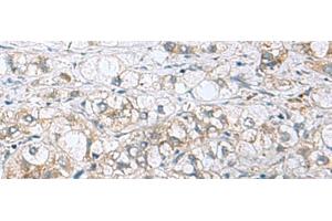Immunohistochemistry of paraffin-embedded Human liver cancer tissue using PHPT1 Polyclonal Antibody at dilution of 1:210(x200) (PHPT1 antibody)