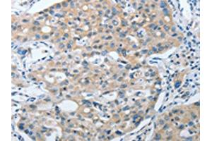 The image on the left is immunohistochemistry of paraffin-embedded Human lung cancer tissue using ABIN7128398(ANAPC13 Antibody) at dilution 1/25, on the right is treated with fusion protein. (ANAPC13 antibody)