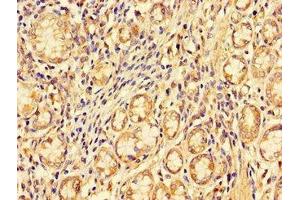 Immunohistochemistry of paraffin-embedded human gastric cancer using ABIN7151097 at dilution of 1:100 (PDZRN3 antibody  (AA 133-404))
