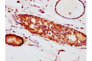 IHC image of ABIN7127691 diluted at 1:100 and staining in paraffin-embedded human breast cancer performed on a Leica BondTM system. (Recombinant EIF4E antibody  (pSer209))
