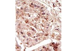 Formalin-fixed and paraffin-embedded human cancer tissue (hepatocarcinoma) reacted with the primary antibody, which was peroxidase-conjugated to the secondary antibody, followed by DAB staining. (STK31 antibody  (C-Term))