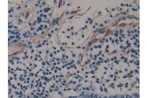 Detection of AREG in Human Skin cancer Tissue using Monoclonal Antibody to Amphiregulin (AREG) (Amphiregulin antibody  (AA 20-100))