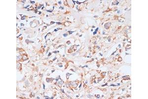 Immunohistochemistry of paraffin-embedded Human breast cancer using EIF4EBP1 Polyclonal Antibody at dilution of 1:100 (40x lens).