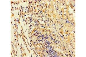Immunohistochemistry of paraffin-embedded human lung cancer using ABIN7171552 at dilution of 1:100 (TAS2R42 antibody  (AA 149-187))