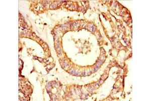 Immunohistochemistry of paraffin-embedded human endometrial cancer using ABIN7161918 at dilution of 1:100 (NRBP2 antibody  (AA 12-258))