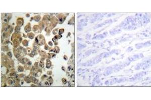 Immunohistochemistry analysis of paraffin-embedded human breast carcinoma, using PKC delta (Phospho-Thr505) Antibody. (PKC delta antibody  (pThr507))