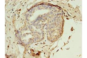 Immunohistochemistry of paraffin-embedded human breast cancer using ABIN7142288 at dilution of 1:100 (EBP antibody  (AA 2-230))