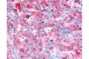 Human Ovarian Carcinoma (formalin-fixed, paraffin-embedded) stained with EGFR antibody ABIN213614 at 2. (EGFR antibody)
