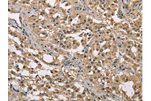 The image on the left is immunohistochemistry of paraffin-embedded Human thyroid cancer tissue using ABIN7129149(DACH2 Antibody) at dilution 1/40, on the right is treated with fusion protein.