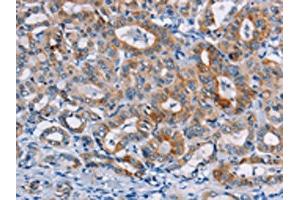 The image on the left is immunohistochemistry of paraffin-embedded Human thyroid cancer tissue using ABIN7128771(CASC3 Antibody) at dilution 1/20, on the right is treated with fusion protein.