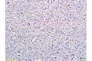 Formalin-fixed and paraffin embedded human cervical carcinoma labeled with Anti Sertad1 Polyclonal Antibody, Unconjugated  at 1:200 followed by conjugation to the secondary antibody and DAB staining (SERTAD1 antibody  (AA 1-42))