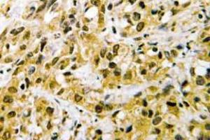 Immunohistochemistry (IHC) analyzes of NF-YC antibody in paraffin-embedded human liver carcinoma tissue. (NFYC antibody)