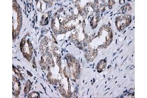 Immunohistochemical staining of paraffin-embedded Carcinoma of thyroid tissue using anti-LIPG mouse monoclonal antibody. (LIPG antibody)