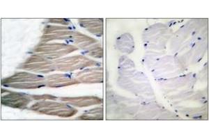 Immunohistochemistry analysis of paraffin-embedded human breast carcinoma, using ACC1 (Phospho-Ser80) Antibody. (Acetyl-CoA Carboxylase alpha antibody  (pSer80))