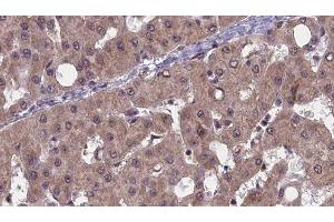 ABIN6277491 at 1/100 staining Human liver cancer tissue by IHC-P. (PAK1 antibody  (Internal Region))