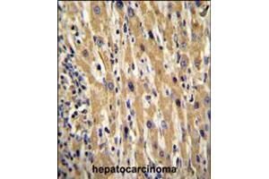 GAL Antibody immunohistochemistry analysis in formalin fixed and paraffin embedded human hepatocarcinoma followed by peroxidase conjugation of the secondary antibody and DAB staining.