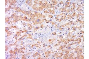 Paraformaldehyde-fixed, paraffin embedded human liver cancer, Antigen retrieval by boiling in sodium citrate buffer (pH6) for 15min, Block endogenous peroxidase by 3% hydrogen peroxide for 30 minutes, Blocking buffer (normal goat serum) at 37°C for 20min, Antibody incubation with Rabbit Anti-Cytochrome b245 Light Chain Polyclonal Antibody, Unconjugated  at 1:500 overnight at 4°C, followed by a conjugated secondary and DAB staining. (CYBA antibody  (AA 21-120))