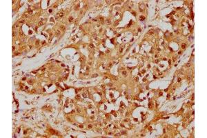 IHC image of ABIN7127533 diluted at 1:125 and staining in paraffin-embedded human liver cancer performed on a Leica BondTM system. (Recombinant GSTO1 antibody)