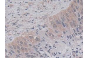 Detection of CYPA in Human Lung cancer Tissue using Monoclonal Antibody to Cyclophilin A (CYPA) (PPIA antibody  (AA 2-165))