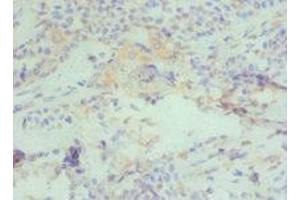 Immunohistochemistry of paraffin-embedded human breast cancer using ABIN7150954 at dilution of 1:100 (CBX4 antibody  (AA 401-560))