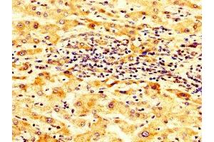 IHC image of ABIN7143973 diluted at 1:300 and staining in paraffin-embedded human liver cancer performed on a Leica BondTM system. (SCNN1B antibody  (AA 554-640))