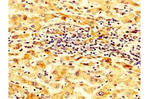IHC image of ABIN7143973 diluted at 1:300 and staining in paraffin-embedded human liver cancer performed on a Leica BondTM system. (SCNN1B antibody  (AA 554-640))