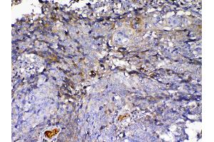 IHC analysis of IGFBP2 using anti-IGFBP2 antibody .