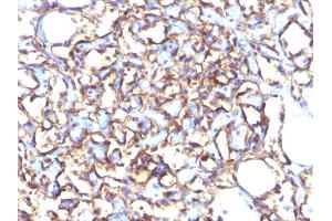 Formalin-fixed, paraffin-embedded human Angiosarcoma stained with Podocalyxin Mouse Monoclonal Antibody (3D3).