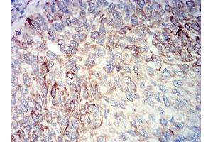 Immunohistochemical analysis of paraffin-embedded lung cancer tissues using BCL2L10 mouse mAb with DAB staining.