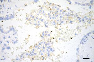 Immunohistochemistry was performed on paraffin-embedded human lung adenocarcinoma using CD274 antibody (ABIN7797962), 1:200). (Recombinant PD-L1 antibody)