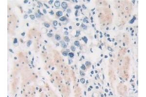 Detection of PKD2 in Human Stomach cancer Tissue using Polyclonal Antibody to Protein Kinase D2 (PKD2) (PKD2 antibody  (AA 621-832))