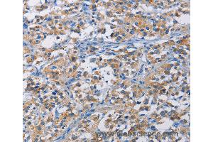Immunohistochemistry of Human liver cancer using RICTOR Polyclonal Antibody at dilution of 1:50 (RICTOR antibody)