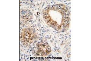 Formalin-fixed and paraffin-embedded human prostata carcinoma tissue reacted with PTGS1 antibody (C-term) (ABIN1882120 and ABIN2839444) , which was peroxidase-conjugated to the secondary antibody, followed by DAB staining. (PTGS1 antibody  (C-Term))
