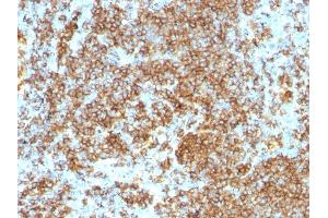 Formalin-fixed, paraffin-embedded human Lymphoma stained with CD45RB Monoclonal Antibody (PTPRC/1132). (CD45 antibody)