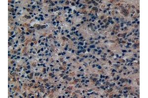 Detection of DISC1 in Human Prostate cancer Tissue using Polyclonal Antibody to Disrupted In Schizophrenia 1 (DISC1) (DISC1 antibody  (AA 102-261))