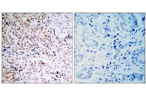 Immunohistochemical analysis of paraffin-embedded human breast carcinoma tissue, using Rb (phospho- Ser795) antibody (E011130). (Retinoblastoma 1 antibody  (pSer795))