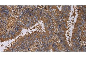 Immunohistochemistry of paraffin-embedded Human colon cancer using FADS1 Polyclonal Antibody at dilution of 1:60 (FADS1 antibody)