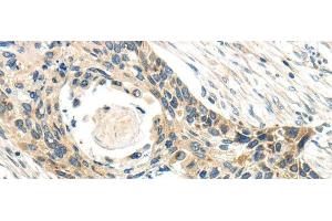 Immunohistochemistry of paraffin-embedded Human esophagus cancer tissue using CCL13 Polyclonal Antibody at dilution 1:40 (CCL13 antibody)