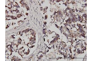 Immunoperoxidase of monoclonal antibody to FXR1 on formalin-fixed paraffin-embedded human colon adenocarcinoma. (FXR1 antibody  (AA 121-220))