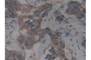Detection of SCFR in Human Breast cancer Tissue using Polyclonal Antibody to Stem Cell Factor Receptor (SCFR) (KIT antibody  (AA 321-520))