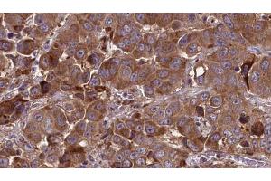 ABIN6273837 at 1/100 staining Human liver cancer tissue by IHC-P. (Serotonin Receptor 3A antibody  (Internal Region))