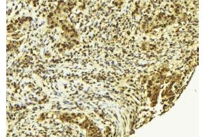 ABIN6278092 at 1/100 staining Human breast cancer tissue by IHC-P. (alpha Actinin 4 antibody  (C-Term))