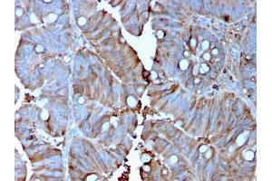 Formalin-fixed, paraffin-embedded human Colon Carcinoma stained with MerTK Mouse Monoclonal Antibody (MERTK/3015). (MERTK antibody  (AA 55-148))