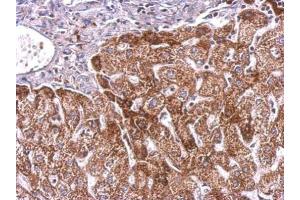 IHC-P Image PLGF antibody detects PGF protein at cytosol on human hepatoma by immunohistochemical analysis. (PLGF antibody)